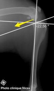 rupture ligament croisé - genou angle plateau tibial