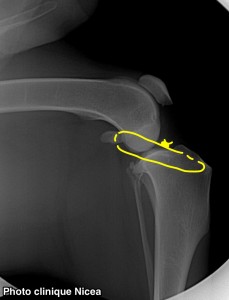 rupture ligament croisé - stabilisation extra capsulaire